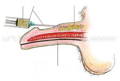 mezinbûna penîsê derzîlêdanê